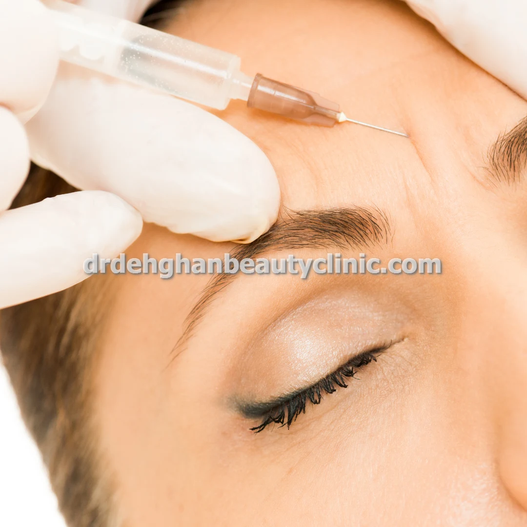 بوتاکس برای خطوط اخم پیشانی در فردیس